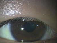 なんどもものもらいを繰り返す 調べてみると糖尿病が見つかった方が ある奈良県の眼科医が目について書いたブログ なんどもものもらいを繰り返す 調べてみると糖尿病が見つかった方が ある奈良県の眼科医が目について書いたブログ