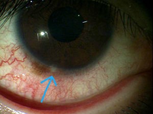 カラーコンタクトレンズ カラコン はこれだけ危険 その理由と トラブルを起こされた方の写真です ある奈良県の眼科医が目について書いたブログ