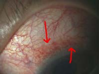 カラコンの危険性 カラコンの酸素透過性は最低レベル 酸素透過性から見たカラコンの危険性 透明のレンズやディファインレンズとの比較 ある奈良県の眼科医が目について書いたブログ