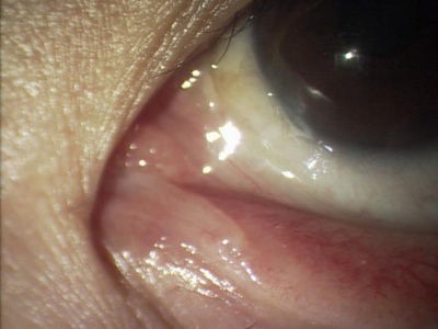 点眼を使っても治らないめやに このように涙小管炎の中に涙小管結石があるとお薬に抵抗性で切開で改善する病気なのです ある奈良県の眼科医が目 について書いたブログ
