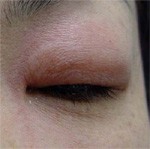 花粉症の時期にはまぶたを腫らして来院されることがあります しかし それ以外の病気でもまぶたが腫れることも ある奈良県の眼科医が目について書いたブログ