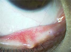 マイボーム腺梗塞 瞼に白いできもの その裏側にも白い塊がありごろごろする ものもらい めばちこ に発展することも ある奈良県の眼科医が目について書いたブログ