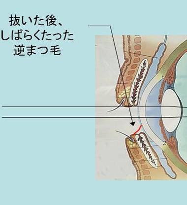 逆まつ毛 抜く と思われがちですが 場合によっては抜かなくてもよい時もあります ある奈良県の眼科医が目について書いたブログ