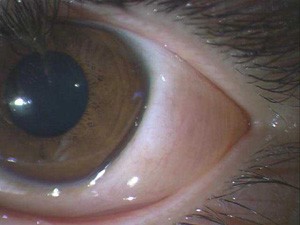 花粉症で目をこすりすぎるとまつ毛が抜けて瞼の裏側に入ることがあります その他 アレルギー性結膜炎の方が目をこするといろいろなことがおこります ある奈良県の眼科医が目について書いたブログ