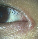 まぶたがカサカサしてかゆい 眼瞼湿疹でステロイドの軟膏で治らない時には こんな時にはこんな治療も ある奈良県の眼科医が目について書いたブログ