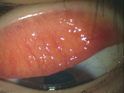 コンタクトレンズのアレルギー性結膜炎の症状と原因 すぐにくもる かゆい レンズが上に上がる 原因はレンズの汚れと硬さ シリコーンハイドロゲルレンズの硬さもその原因に ある奈良県の眼科医が目について書いたブログ