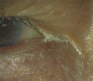 目の中に白い泡があり瞼の縁に付く これはドライアイを合併している可能性があり要注意です ある奈良県の眼科医が目について書いたブログ