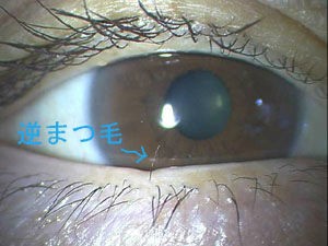 逆まつ毛 抜く と思われがちですが 場合によっては抜かなくてもよい時もあります ある奈良県の眼科医が目について書いたブログ
