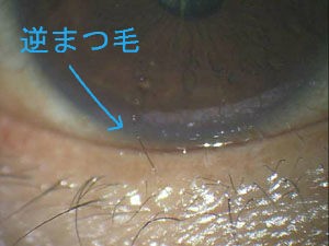 逆まつ毛 抜く と思われがちですが 場合によっては抜かなくてもよい時もあります ある奈良県の眼科医が目について書いたブログ