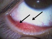 瞼 白い 下 目の症状(下瞼の裏側に白い“できもの”)
