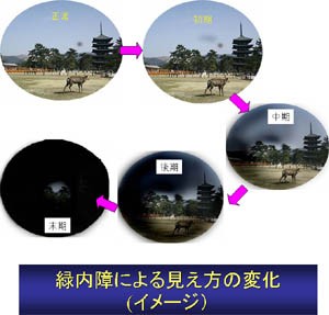 ヨガで眼圧が上がり緑内障が進行し視野が欠けた方 眼圧の上がる原因は意外なことからも ある奈良県の眼科医が目について書いたブログ