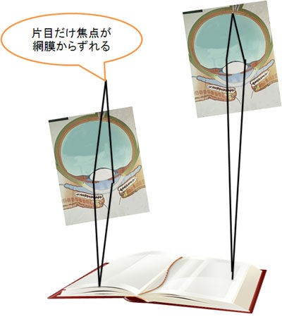 片目だけ近視が進行するのはなぜ 視力の左右差の原因と対策 ある奈良県の眼科医が目について書いたブログ 片目だけ近視が進行するのはなぜ 視力の左右差の原因と対策 ある奈良県の眼科医が目について書いたブログ