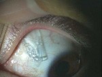 コンタクトレンズが行方不明 コンタクトレンズやその破片が眼球の裏側に回ることってあるの ある奈良県の眼科医が目について書いたブログ
