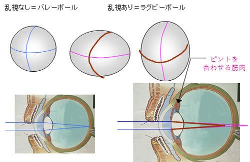 乱視用ソフトコンタクトレンズが合わない方 あきらめてはいけません 乱視用ソフトコンタクトレンズには2つのパターンがあり 人によって適性があります ある奈良県の眼科医が目について書いたブログ