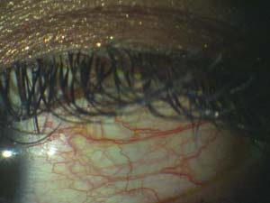 13年のまつ毛エクステ マツエク での目の障害から見る最近のトラブルの傾向 年齢 症状 その原因からその実態をみてみました ある奈良県の眼科医が目について書いたブログ