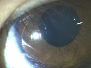 外傷性散瞳は眼球打撲後の瞳孔異常 しかし 待っているうちに症状が自然に治ることも ある奈良県の眼科医が目について書いたブログ