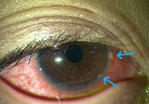 2weekメニコンreiは酸素透過性も良好 乱視も矯正でき サイズも大きいのでより眼球が大きくみえるカラコンです ある奈良県の眼科医が目について書いたブログ