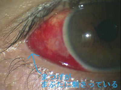 結膜下出血の原因 最近の説 注意点 繰り返す場合の再発予防 ある奈良県の眼科医が目について書いたブログ