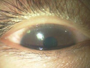 カラコンから色素が脱落して眼球に付着した症例 カラコンユーザーはこんなことにも注意を ある奈良県の眼科医が目について書いたブログ