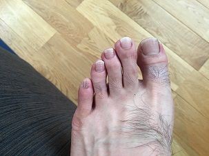 痛い 足 の 指 が 足の指（趾）のケガ（家具などにぶつけた）
