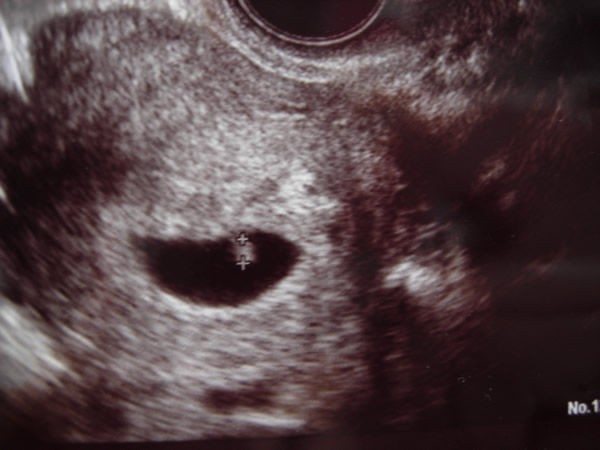 妊娠6週通院日 キラキラ ふぉーてぃー ニコニコ ｖ 体外受精 顔晴る高齢出産への道