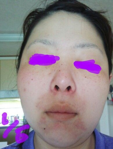 脂漏性湿疹日記 ニゾラールのみ１日目 ヤルシカナイ