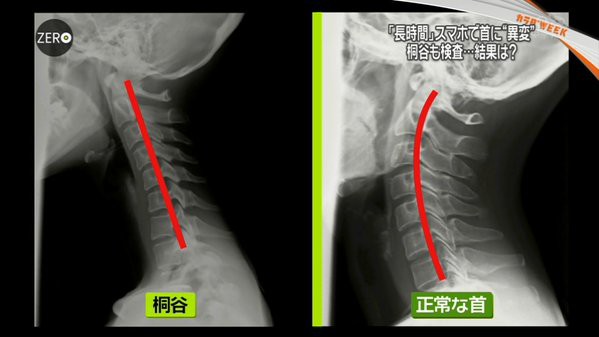 桐谷美玲 日テレ News Zero スマホ現代病 特集で受けた検診時の姿が話題に 芸能ニュース鬼まとめ 2chまとめブログ