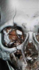 父は頭蓋骨骨折 アルコール依存症者の家庭で育った