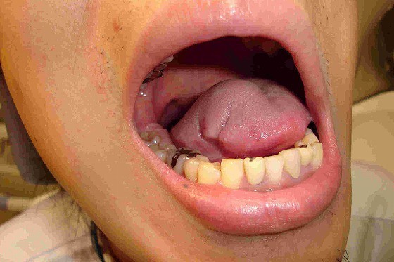 がんになりまして 出血。 : ビールが好きなんです。 Powered by 