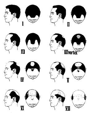 ハゲ レモン汁を頭皮に塗るだけで髪が生えると発表される 逆に