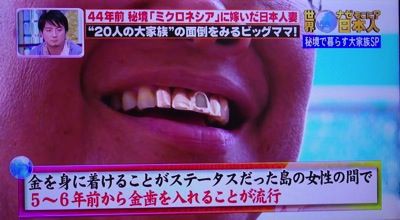 前歯に金歯を入れるのが流行っている国 気まぐれブログ