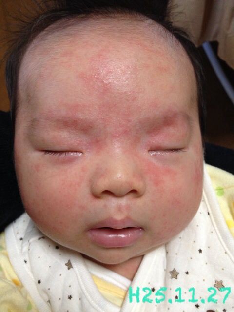 乳児湿疹 はちこblog