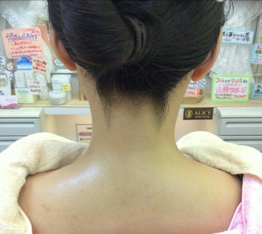 成人式シェービング やらなきゃ損 えりあしうなじ剃るとどうなる 解説付き ビフォー アフター ブライダルシェービング埼玉県戸田市ビューティーシェービングaliceアリス 成人式シェービング やらなきゃ損 えりあしうなじ剃るとどうなる 解説付き ビフォー アフター ブライダルシェービング埼玉県戸田市ビューティーシェービングaliceアリス