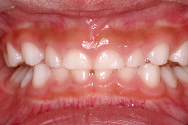 印刷可能 歯ぎしり 彼女 歯ぎしり 彼女 Muryothink