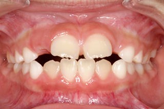 乳歯の白さと永久歯の黄色さ 歯医者さんの子育て