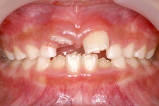 上の前歯が変なとこに生えてきました 歯医者さんの子育て