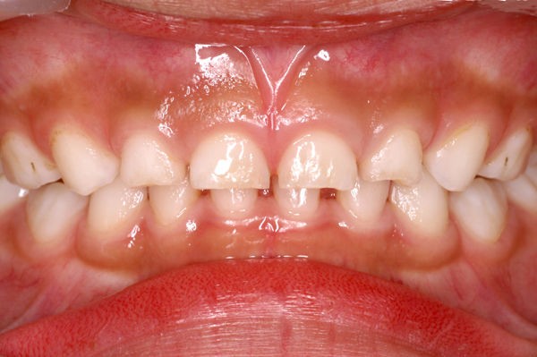 印刷可能 歯ぎしり 彼女 歯ぎしり 彼女 Muryothink