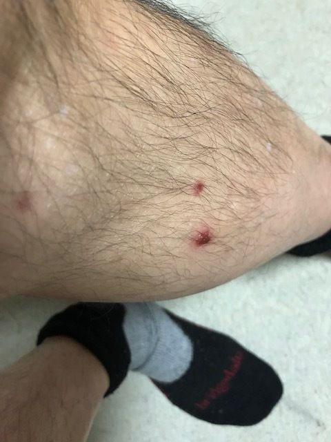 マダニ感染症 はこだて自然倶楽部 続 風を追って マダニ感染症 はこだて自然倶楽部 続 風を追って