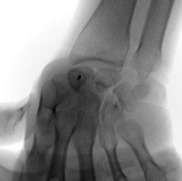 背側アプローチでの舟状骨骨折手術 : 整形外科医のブログ