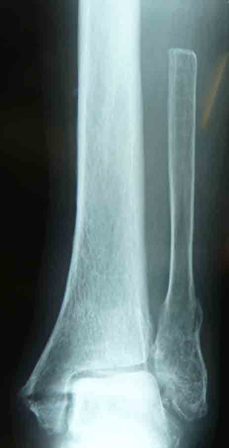 腓骨欠損例の足関節脱臼骨折 整形外科医のブログ