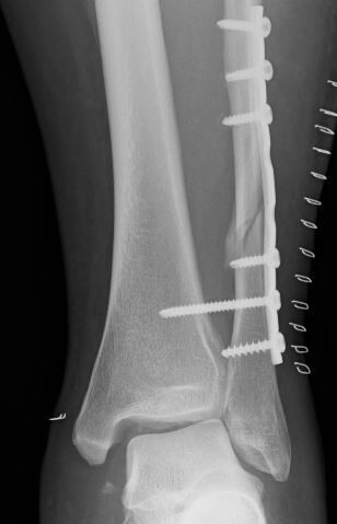 足関節脱臼骨折では三角靭帯縫合が必要か 整形外科医のブログ