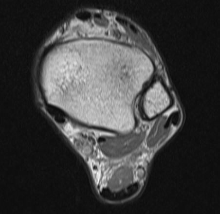 腓骨筋腱脱臼のmri所見 整形外科医のブログ