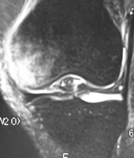 膝骨壊死でも 発生 と 発症 は違う 整形外科医のブログ