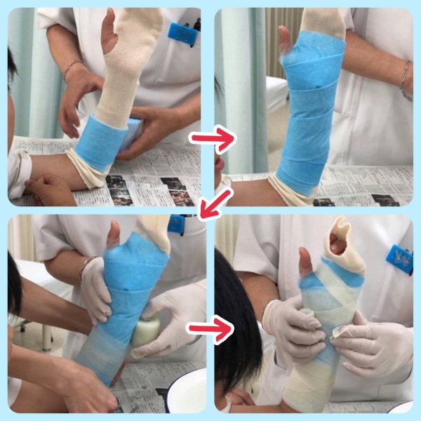 子どもの骨折 若木骨折 １週間目の備忘録 骨折 10歳 写真で魅力発掘 暮らしのフォトダイアリー Powered By ライブドアブログ