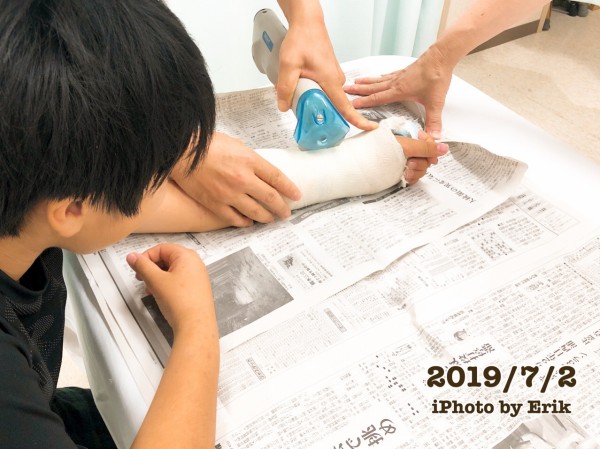 小学生男子の骨折はこんな治療経過 私の骨折話 骨折 10歳 写真で魅力発掘 暮らしのフォトダイアリー Powered By ライブドアブログ