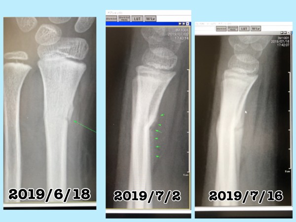 小学生男子の骨折はこんな治療経過 私の骨折話 骨折 10歳 写真で魅力発掘 暮らしのフォトダイアリー Powered By ライブドアブログ