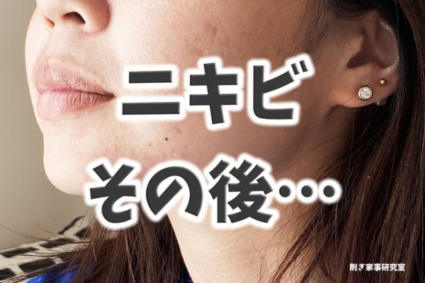 ニキビがなかなか治らない 結局 コレ Happy Living 削ぎ家事研究室 Powered By ライブドアブログ