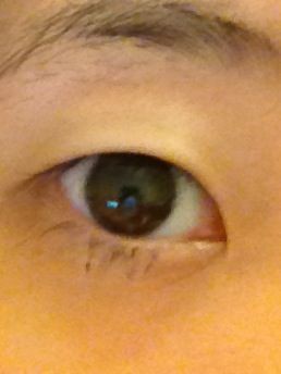 埋没法当日 メリーの埋没法経過ブログ O