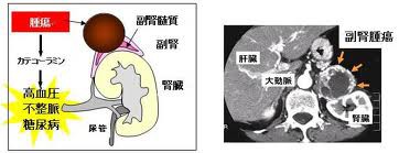 褐色細胞腫 かっしょくさいぼうしゅ 病気ラボ