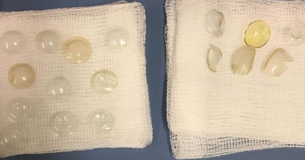 恐怖 コンタクトつけっぱで寝るヤツ注意 白内障の手術をしたら女性の目から27枚のコンタクトレンズ はちま起稿